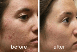 OBI-institute-Botox-Before-an-Before-and-After_6