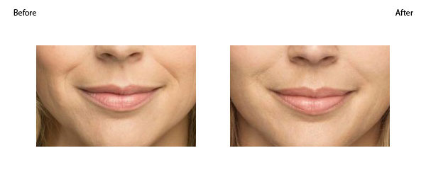 OBI-institute-Belotero-Balance-Before-and-After_2