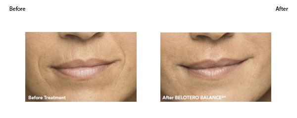 OBI-institute-Belotero-Balance-Before-and-After_2