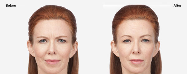 OBI-institute-Botox-Before-an-Before-and-After_2