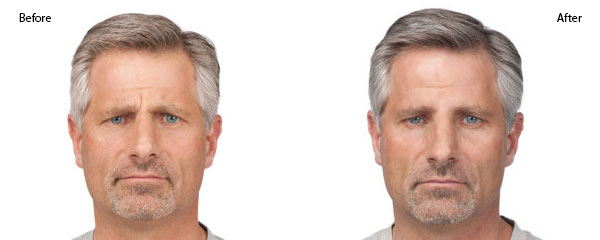OBI-institute-Botox-Before-an-Before-and-After_6