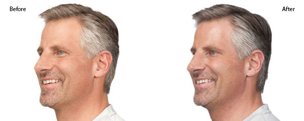 OBI-institute-Botox-Before-an-Before-and-After_7