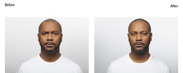 OBI-institute-Dysport-Before-And-After-Pictures_1