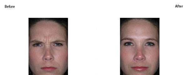 OBI-institute-Dysport-Before-And-After-Pictures_2