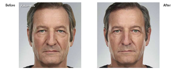 OBI-institute-Juvederm-Before-and-After-Pictures_6
