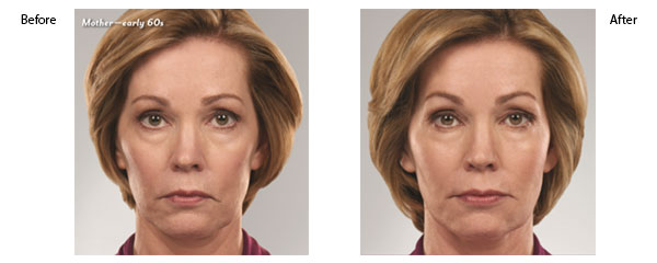 OBI-institute-Juvederm-Before-and-After-Pictures_7