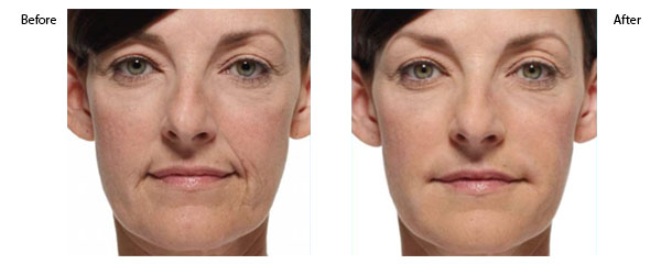 OBI-institute-Radiesse-Before-and-After-Pictures_2
