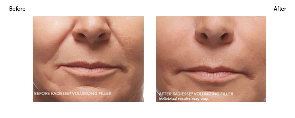 OBI-institute-Radiesse-Before-and-After-Pictures_3