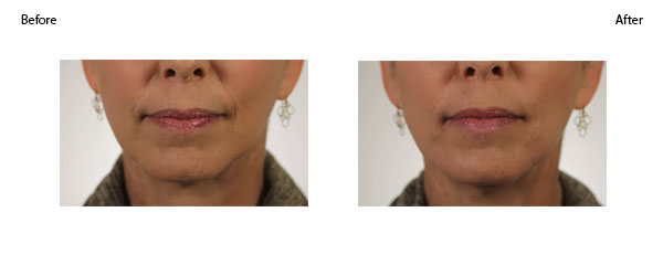 OBI-institute-Revanesse-Versa-Before-and-After-Pictures_2
