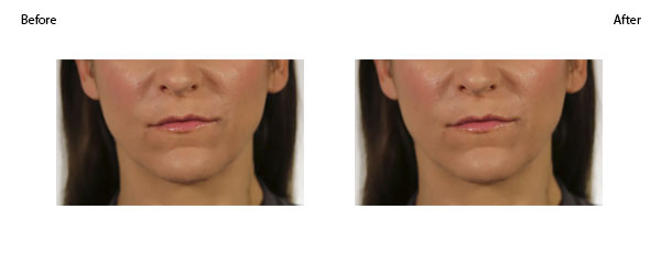 OBI-institute-Revanesse-Versa-Before-and-After-Pictures_3