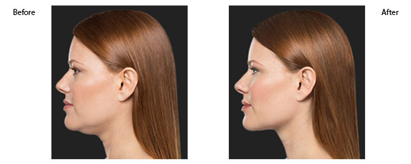 OBI-institute-kybella-Before-and-After-Pictures_2
