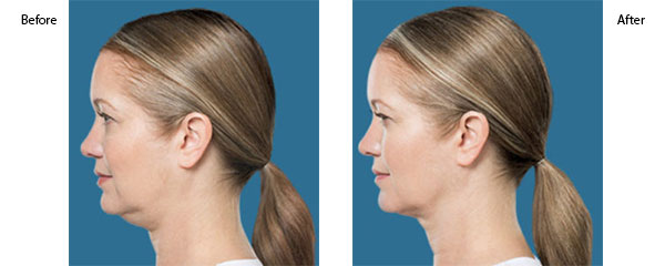 OBI-institute-kybella-Before-and-After-Pictures_3