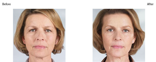OBI_institute_Sculptra_before_and_after-v2