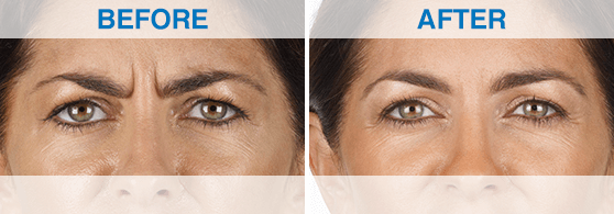 Raquel_Before-And-After-xeomin