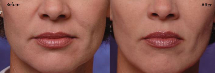 Restylane-4