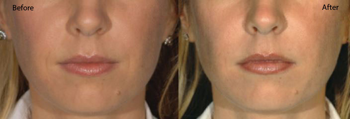 Restylane-Lyft-3