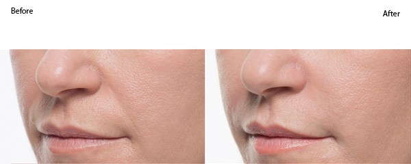 Bellafill_Smile_Patient_5_before_after-side-by-side