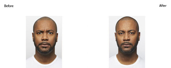 OBI-institute-Dysport-Before-And-After-Pictures_1