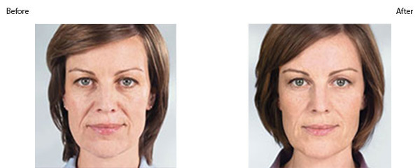 OBI_institute_Sculptra_before_and_after-v2