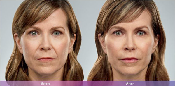 Juvederm-Before-and-After-3-768×439