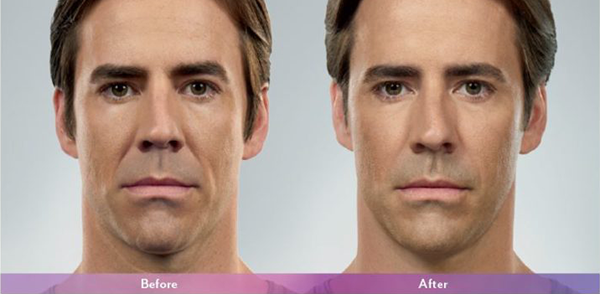 Juvederm-Before-and-After-4-male-768×506