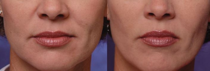 Restylane-4