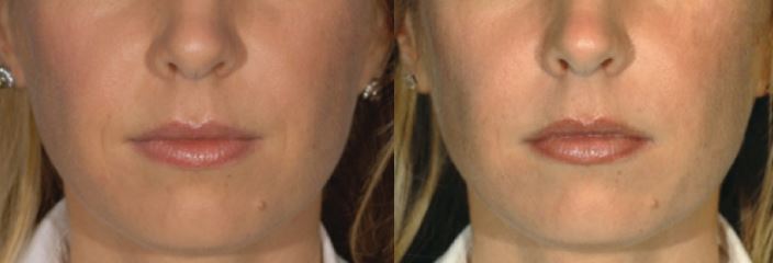Restylane-Lyft-3