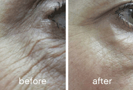 SKINADE_Anti-ageing results after 30 days