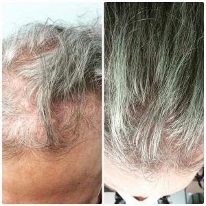 Synthetic Hair Growth Factor - Obi Bioaesthetic Institute