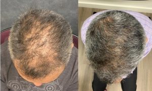 Synthetic Hair Growth Factor - Obi Bioaesthetic Institute