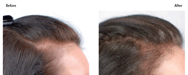 PRP for Thinning Hair
