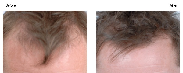 PRP for Thinning Hair