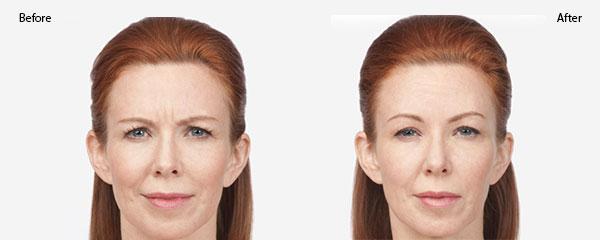 female botox before and after