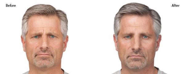 male botox before and after